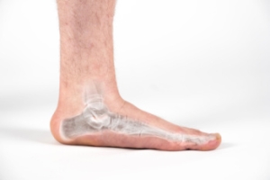 Exercises Aimed at Flat Feet