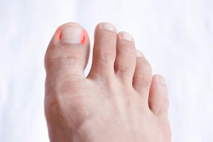 Understanding Ingrown Toenails