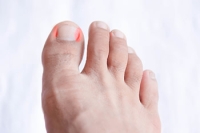 Understanding Ingrown Toenails
