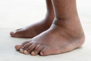 Foot Swelling Caused by Psoriatic Arthritis