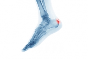 The Definition of a Heel Spur