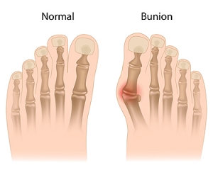 Deformities From Bunions