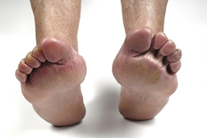 Rheumatoid Arthritis and Its Impact on Feet and Ankles