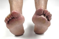 Rheumatoid Arthritis and Its Impact on Feet and Ankles