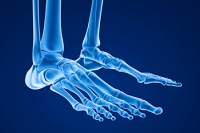 Managing Foot Stress Fractures