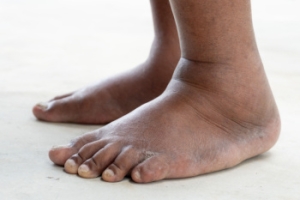 Edema in the Foot and Ankle
