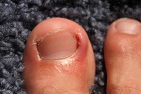 Preventing an Ingrown Toenail